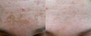 anti-aging Recovery kezelés májfolt eltüntetése