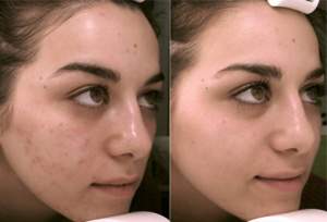 anti-aging Recovery kezelés pattanás eltűntetése