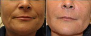 anti-aging Recovery kezelés ráncok eltűntetése